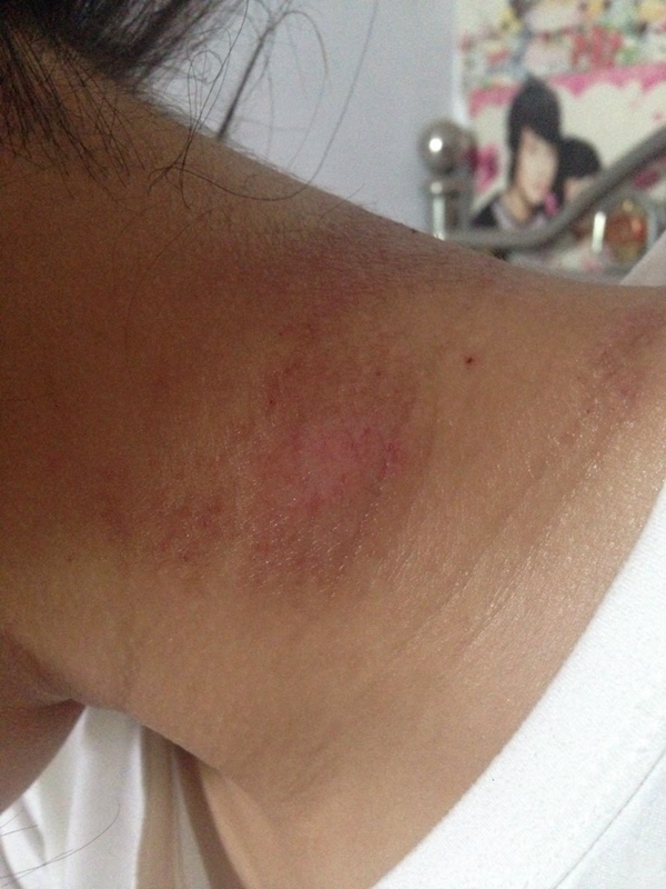 藥物性皮炎脖子紅色區域