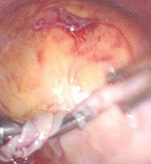 輸卵管囊腫手術