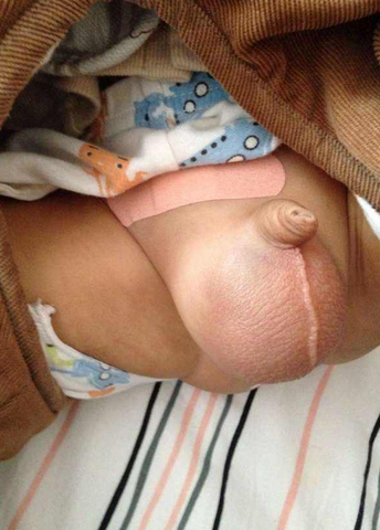 腹股溝斜疝 (59) 