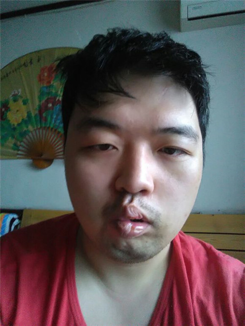 怎麼防治面癱的