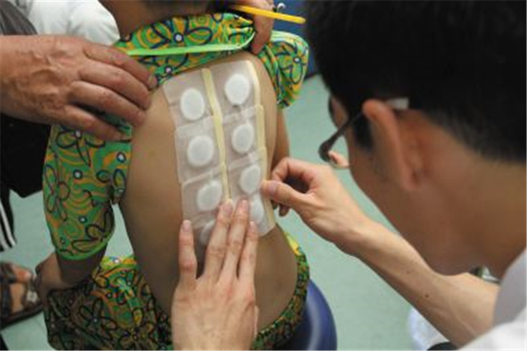 穴位貼敷治療兒童慢性支氣管炎