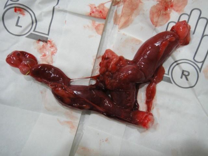 子宮脫垂手術照片