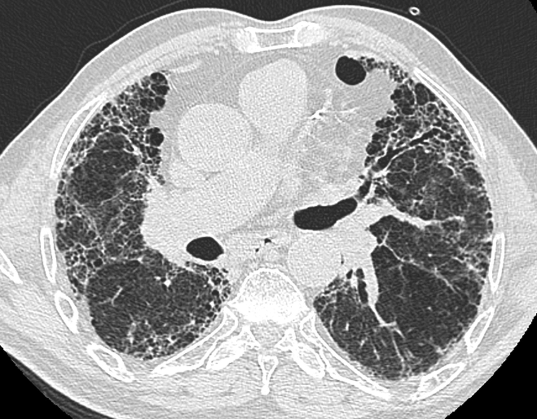 ＿特發性肺纖維化的高清CT圖像