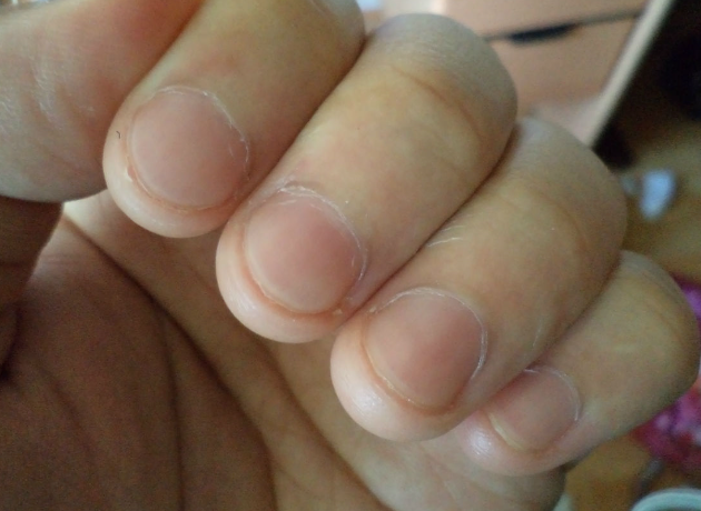 貧血指甲