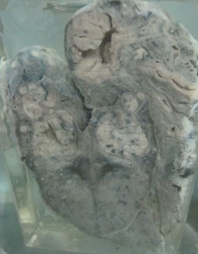 空洞型肺結核能活多久 (9) 