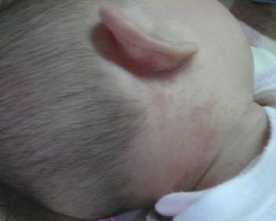 小兒急疹的症狀 (44) 