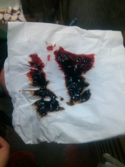 腸癌的症狀 (42) 