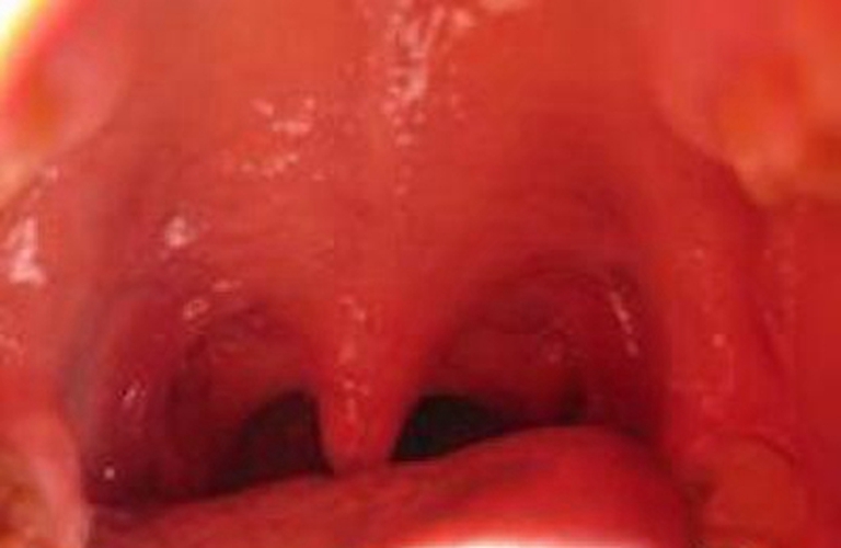 孕期急性咽炎的