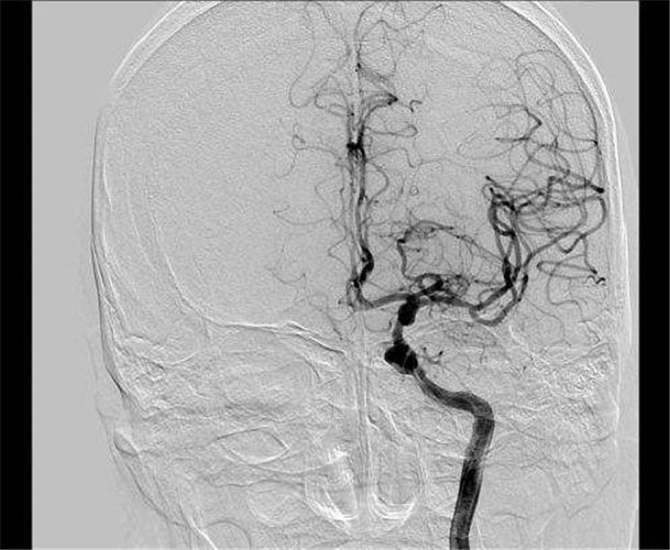 腦供血不足造影