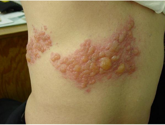 帶狀皰疹樣外觀