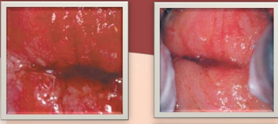 淋病的症狀 (56) 