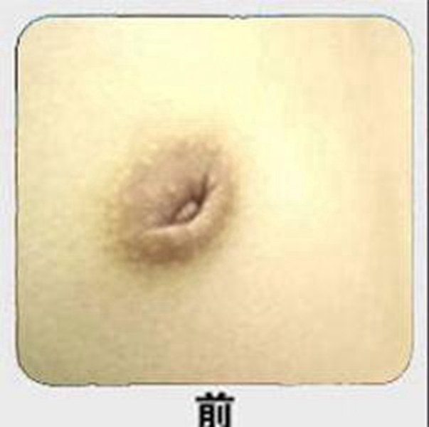 什麼叫乳頭內陷