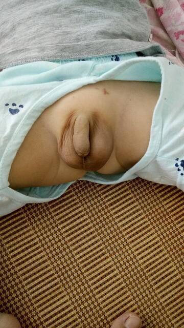 小兒鞘膜積液 (39) 