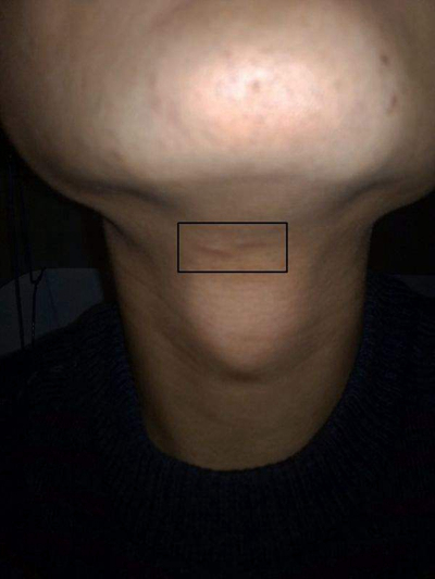 頜下淋巴結腫大