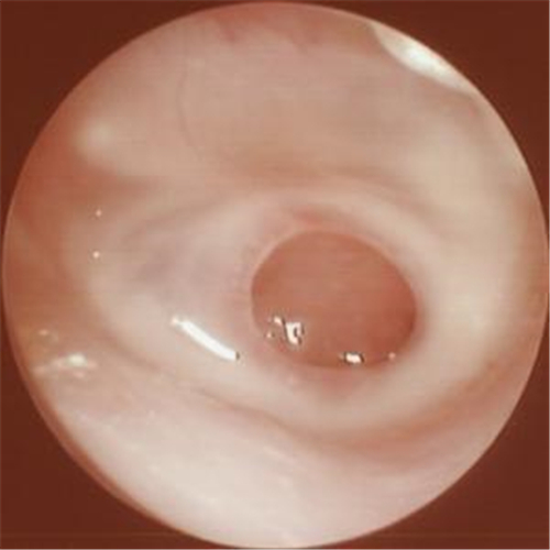秋季急性中耳炎