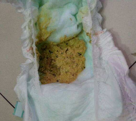 新生兒消化不良大便圖 (8) 