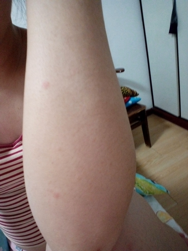 小兒腿部症狀流感