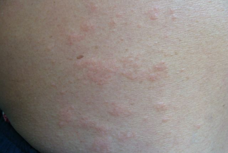 腹部夏季皮炎症狀