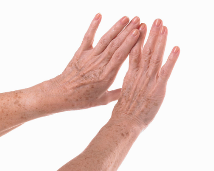 靜止性震顫 (51) 