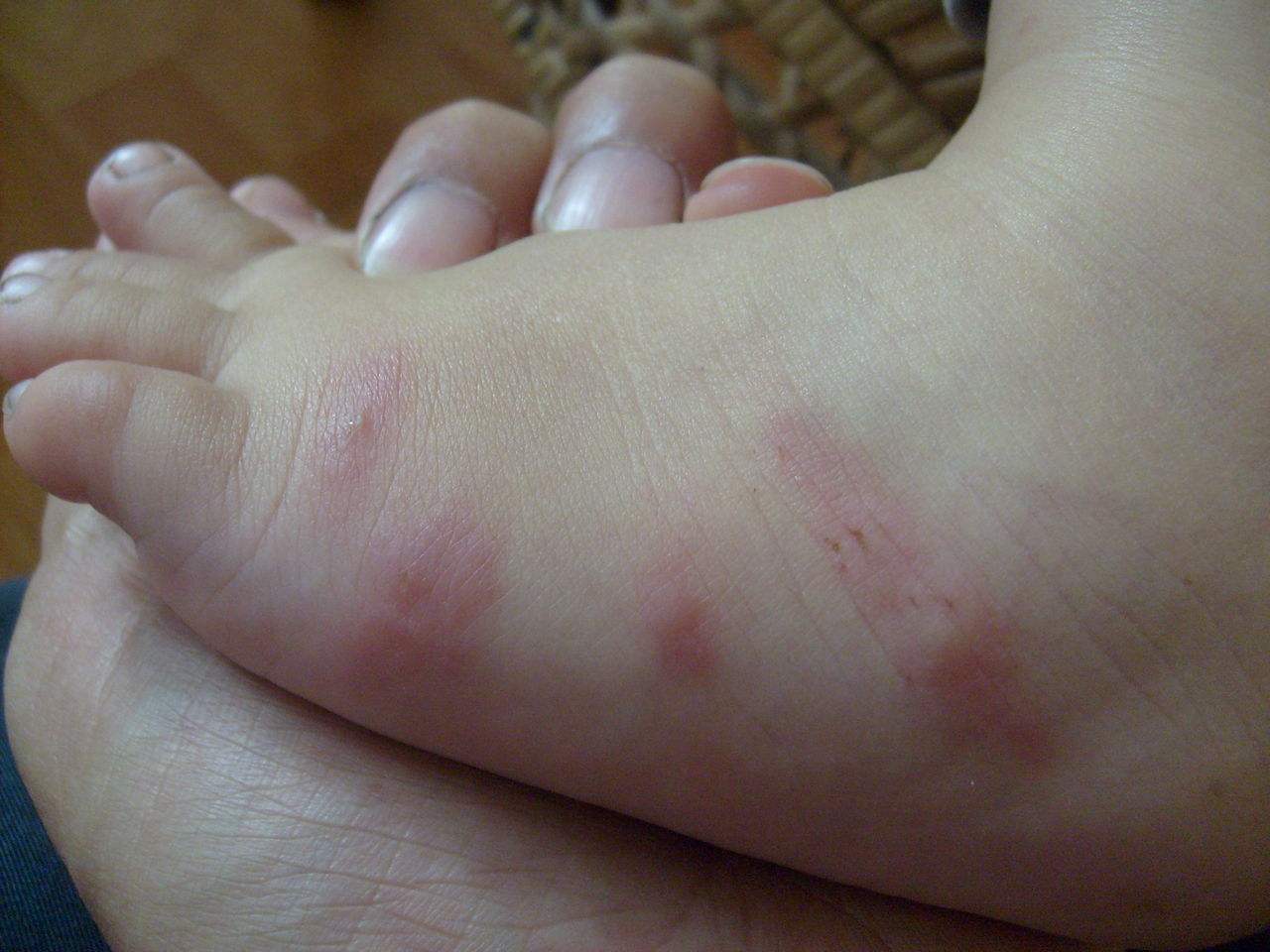 慢性淋巴結炎 (48) 