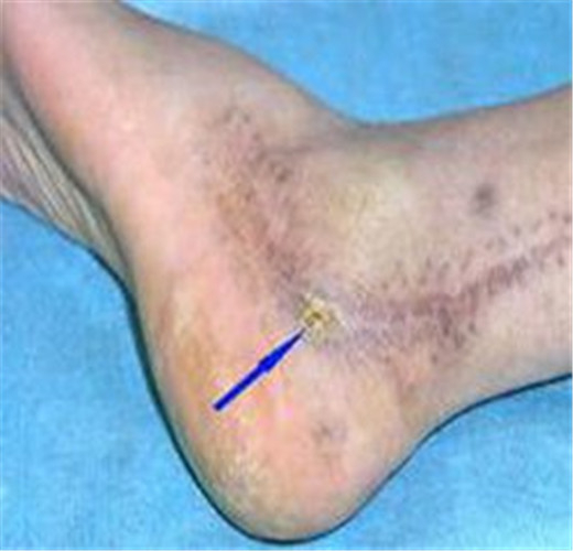 早期骨髓炎腿部治療