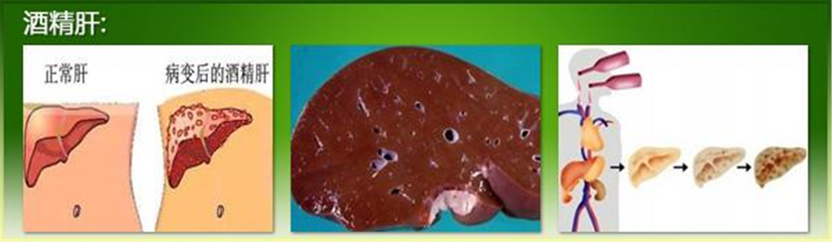 酒精肝的