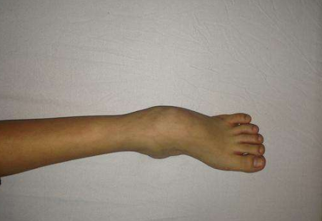 痙攣型腦癱 (55) 