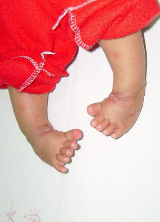 痙攣型腦癱 (58) 