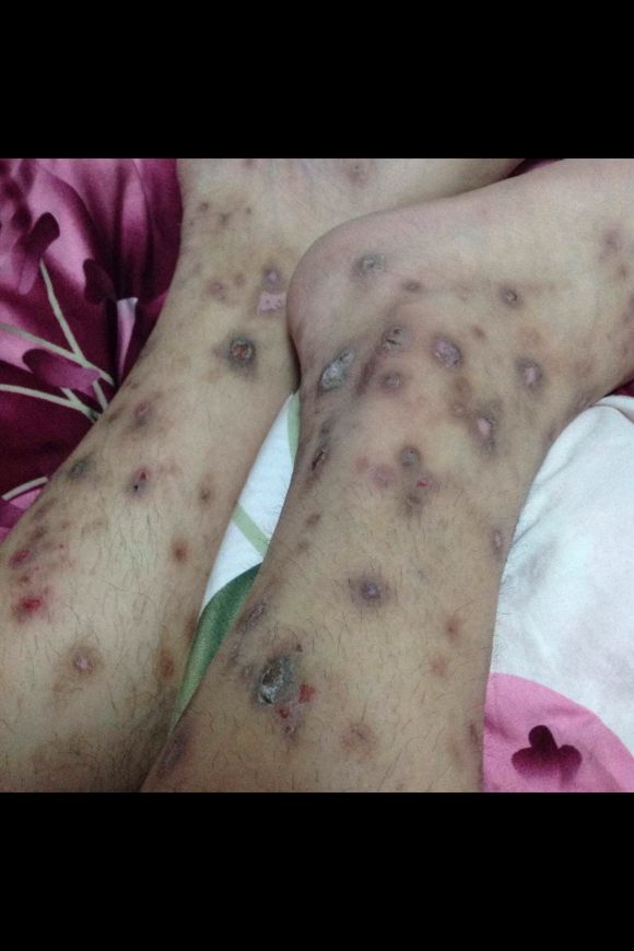 結節性癢疹 (49) 