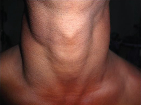 頸靜脈怒張 (34) 