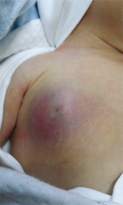 乳房溼疹 (6) 
