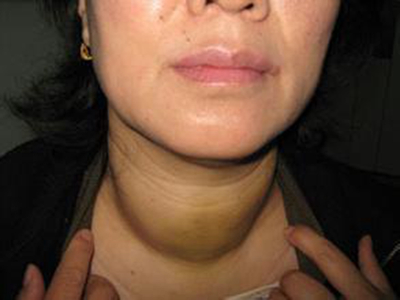 橋本甲狀腺炎右葉結節