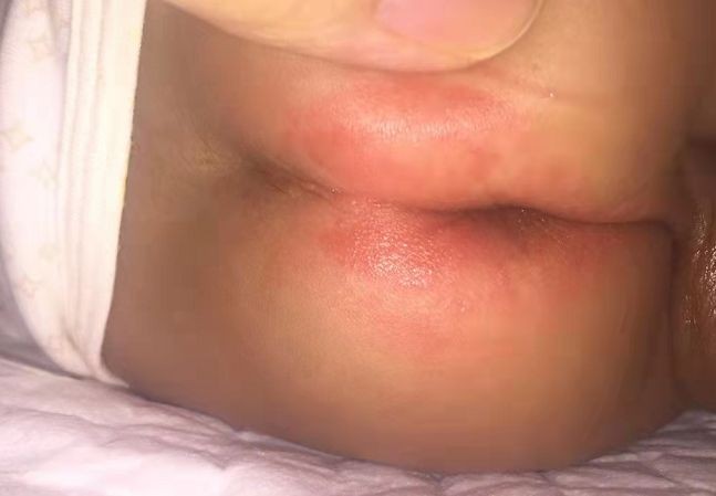 寶寶紅屁屁照片 (55) 