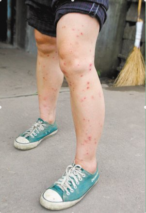 身體蟎蟲過敏症狀