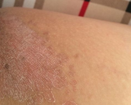 體股癬初期現象