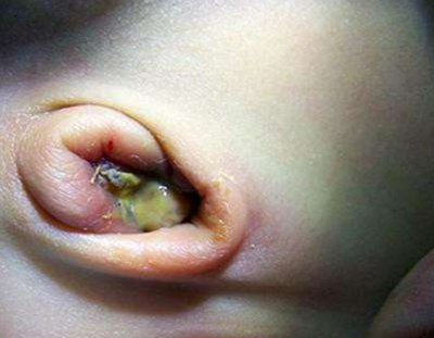 寶寶臍帶脫落後