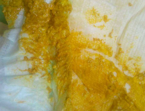 新生兒消化不良大便圖 (6) 