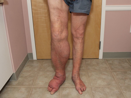 肢端肥大症  (33) 