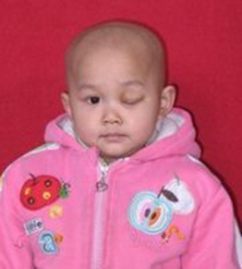 嬰兒青光眼症狀