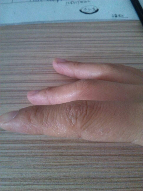 手部溼疹的