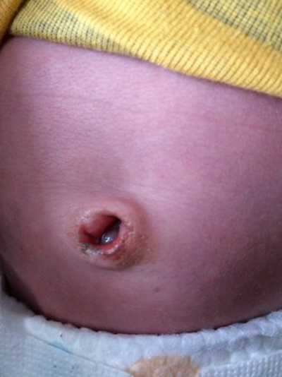 寶寶臍疝