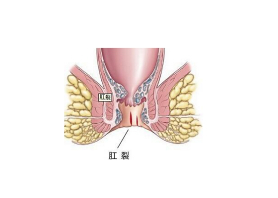 嬰兒肛周膿腫 (1) 