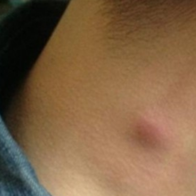 青少年腋下淋巴癌早期症狀的