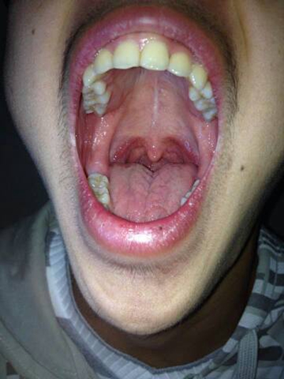 食道炎的症狀圖 (49) 