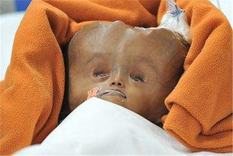 治療中的腦積水