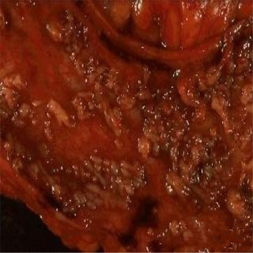 潰瘍性結腸炎重度糜爛