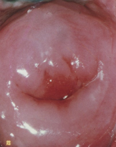 淋病的症狀 (42) 