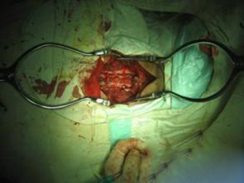 幼兒頸部手術煙霧病