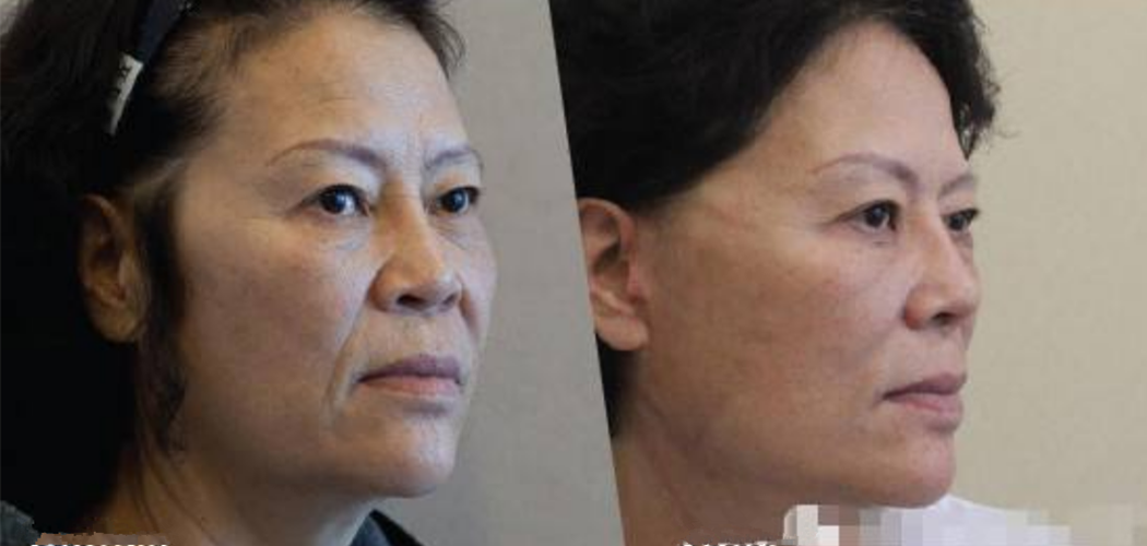 面部的皮膚老化