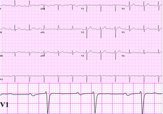 房顫心電圖特點 (58) 